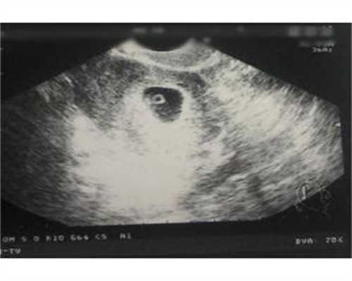 代孕11周胎儿彩超图